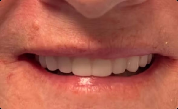 The image shows a close-up of a person s face with a wide smile, focusing on the mouth and teeth area.