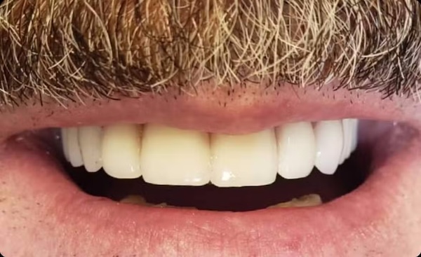 The image shows a close-up of a person s face with a large, white smile featuring straight teeth and a well-groomed mustache, set against a neutral background.