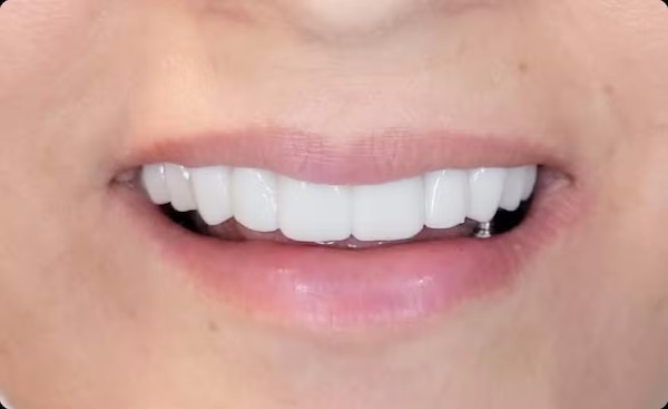 The image features a close-up of a person s face, focusing on their mouth with teeth showing, against a blurred background.