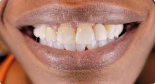 The image features a close-up of a person s mouth with teeth that appear to be discolored or yellowed, likely for dental care or cosmetic purposes.