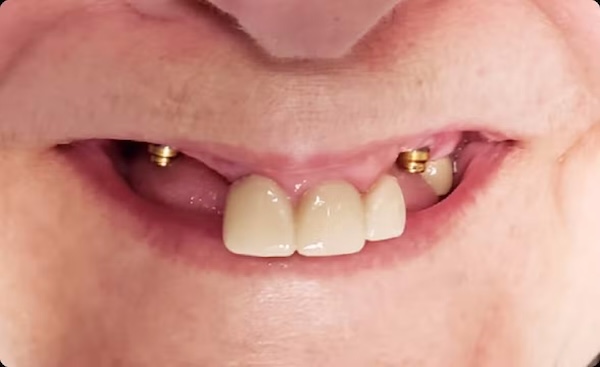 The image shows a close-up of an older individual s mouth with crooked teeth and gold fillings, displaying a wide smile.