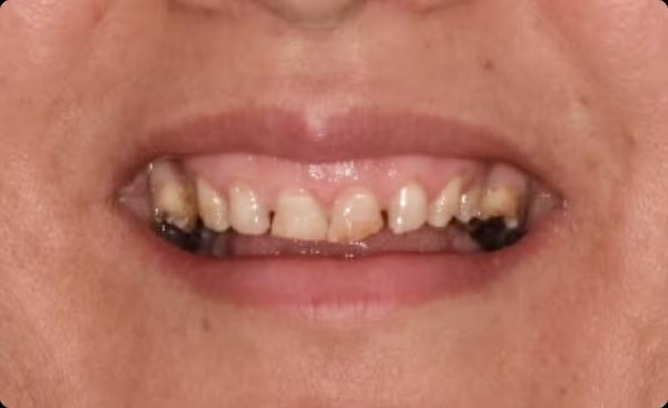 The image shows a close-up of a person s smiling face with an open mouth revealing yellowed teeth and a visible dental implant, set against a blurred background that suggests a medical or dental office.